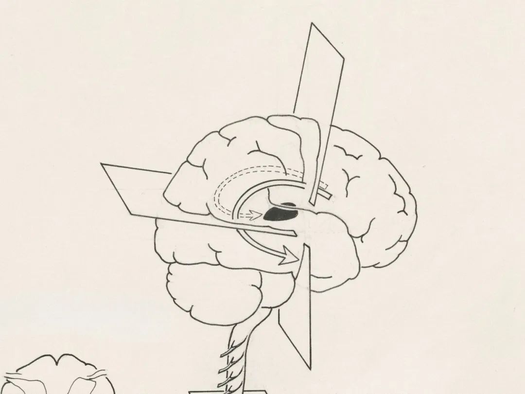 切割手术_人生切割术_切割术失败